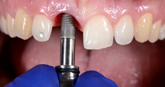 implantes dentales en valencia