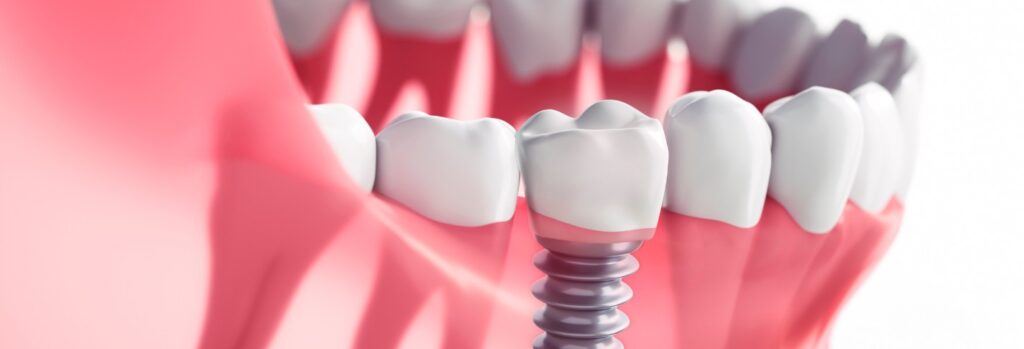 presupuesto implantes dentales