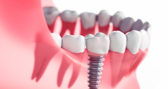 implantologia dental en valencia