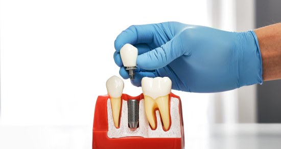 precio implantes dentales valencia