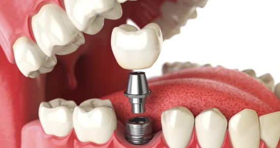 cirugia implante dental valencia