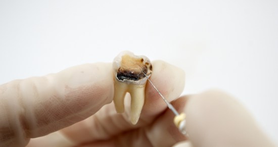 endodoncias dentales en valencia