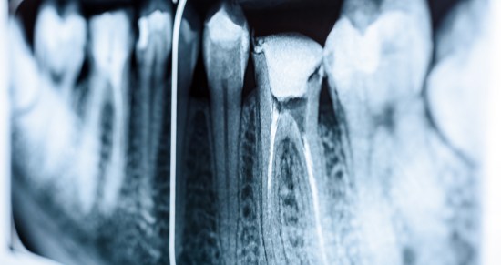 endodoncias dentales valencia