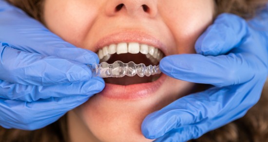 ortodoncia invisalign valencia