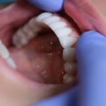 tratamiento carillas dentales valencia
