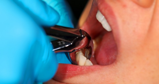 extracciones dentales en Valencia