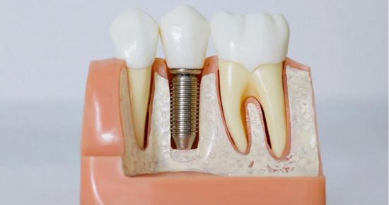 Implantes dentales en Valencia económicos