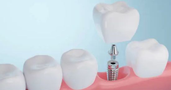 Oferta de implantes dentales en Valencia