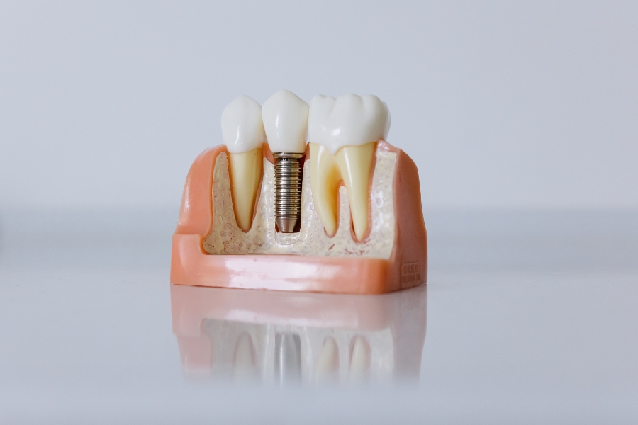 Precio de implantes dentales Valencia